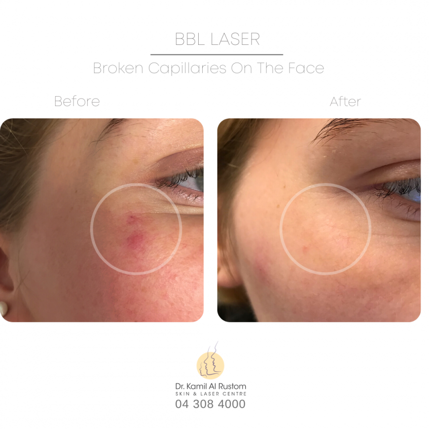 Best dermatologist for broken capillaries on face in Dubai Best treatment for broken capillaries on face in Dubai